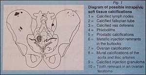 Diagram of possible Intrapelvic soft tissue calcifications - Copyright – Stock Photo / Register Mark