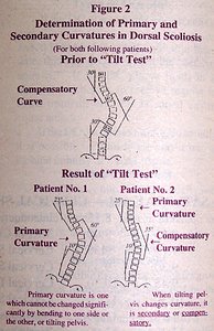 Determination of Primary and Secondary Curvatures in Dorsal Scoliosis - Copyright – Stock Photo / Register Mark