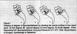 Grading of degree of spondylolisthesis - Copyright – Stock Photo / Register Mark