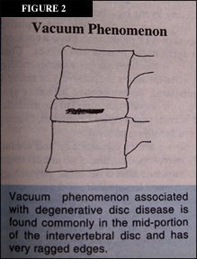 Vacuum Phenomenon - Copyright – Stock Photo / Register Mark