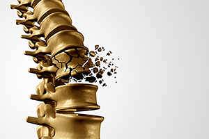 osteoporosis - Copyright – Stock Photo / Register Mark