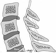 Three common lesions of the intervertebral disc. - Copyright – Stock Photo / Register Mark