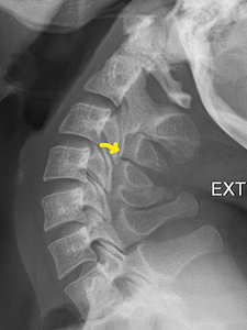 Extension C Spine - Copyright – Stock Photo / Register Mark