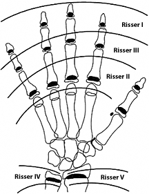 Risser sign and maturation - Copyright – Stock Photo / Register Mark