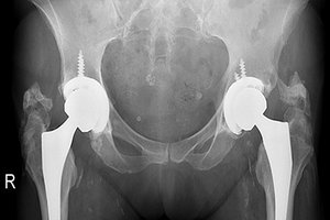 hip arthroplasty - Copyright – Stock Photo / Register Mark