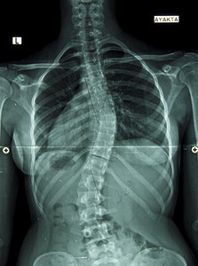 Idiopathic Scoliosis - Copyright – Stock Photo / Register Mark