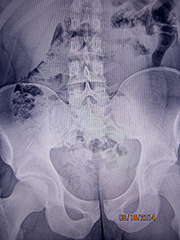 A-P Lumbar - Copyright – Stock Photo / Register Mark