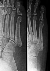 Jones fracture - Copyright – Stock Photo / Register Mark