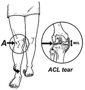 acl tear - Copyright – Stock Photo / Register Mark